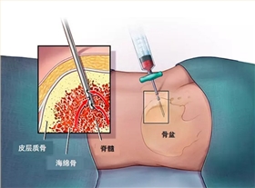 穿刺针冲压厂家